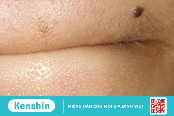 Mụn cám ở cằm: Nguyên nhân, dấu hiệu và cách điều trị 1