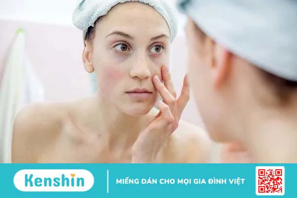 Mụn cám ở cằm: Nguyên nhân, dấu hiệu và cách điều trị 2