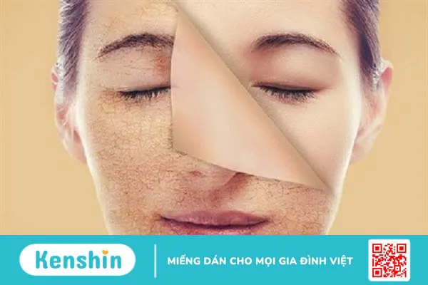 Mụn cám ở cằm: Nguyên nhân, dấu hiệu và cách điều trị 4