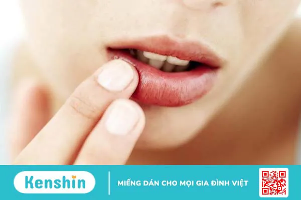 Mụn thịt trong miệng: Nguyên nhân và cách điều trị 2