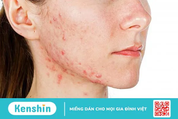 Mụn trứng cá và mụn nhọt khác nhau như thế nào? 1