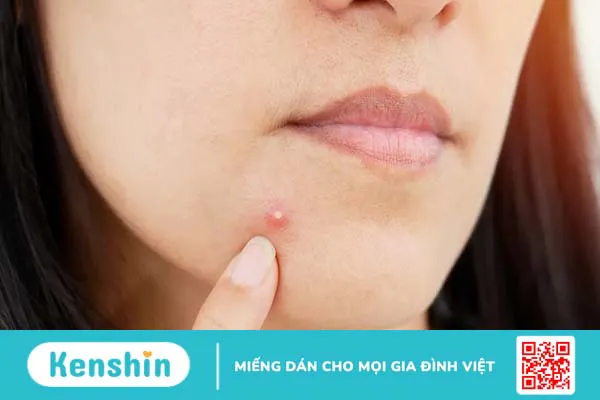 Mụn trứng cá và mụn nhọt khác nhau như thế nào? 3