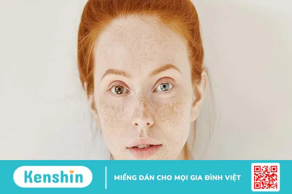 Nám cánh bướm là gì? Tìm hiểu nguyên nhân và phương án điều trị nám cánh bướm