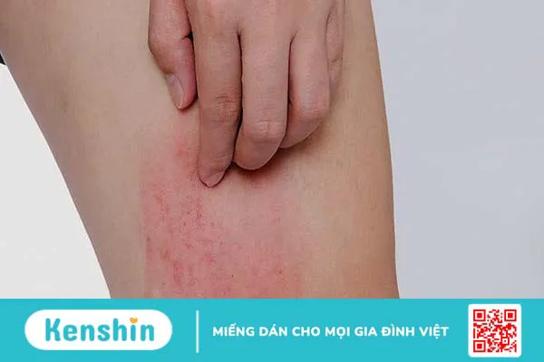 Nấm da đùi: Nguyên nhân, triệu chứng và cách điều trị hiệu quả