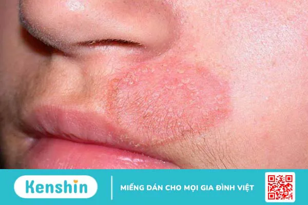 Nấm da mặt: Nguyên nhân, triệu chứng và cách chữa trị