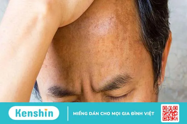 Nám da mặt ở nam giới: Nguyên nhân và phương pháp điều trị