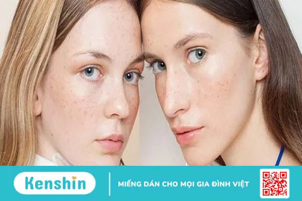 Nám hori là gì? Chữa dứt điểm được không? 4