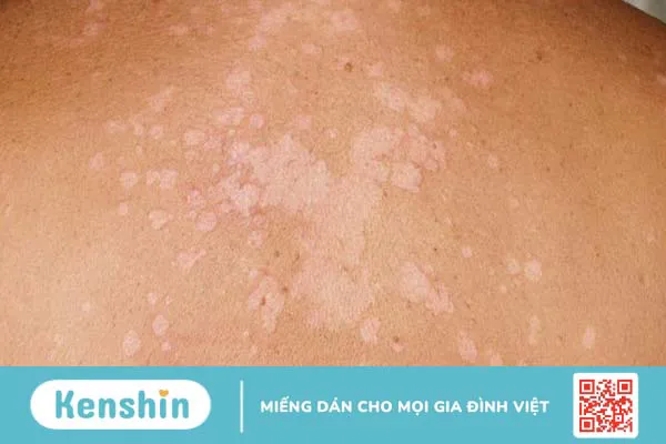 Nấm men Malassezia và tác động đến làn da