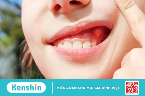 Nắn chỉnh răng mọc ngầm bằng phương pháp gì?