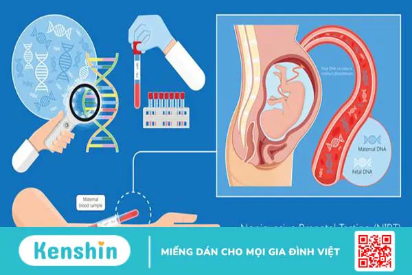 Nang đám rối mạch mạc: Nguyên nhân và cách điều trị