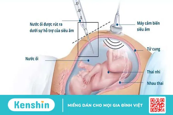 Nang đám rối mạch mạc: Nguyên nhân và cách điều trị