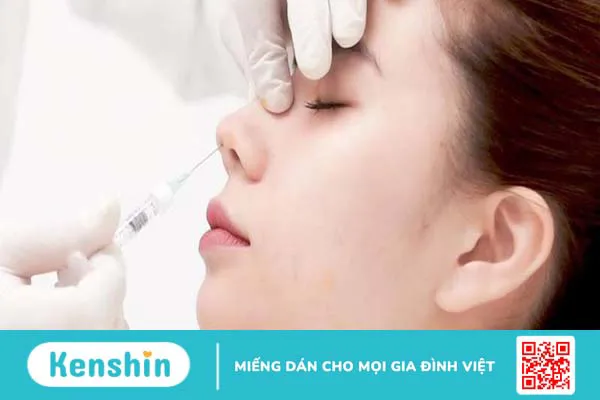 Nâng mũi chỉ Hiko là gì? Một số lưu ý sau khi nâng mũi