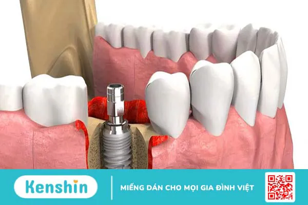 Nâng xoang hở trong cấy ghép Implant có đau không?