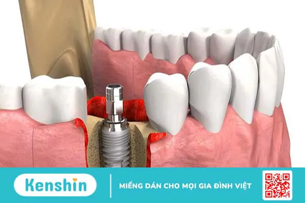 Nâng xoang hở trong cấy ghép Implant có đau không? 1