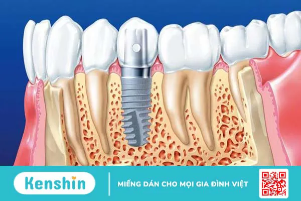 Nâng xoang hở trong cấy ghép Implant có đau không? 2