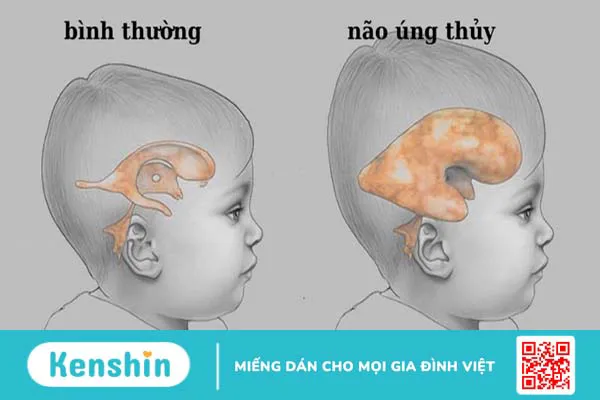 Não úng thủy bẩm sinh: Nguyên nhân, triệu chứng và phương pháp điều trị