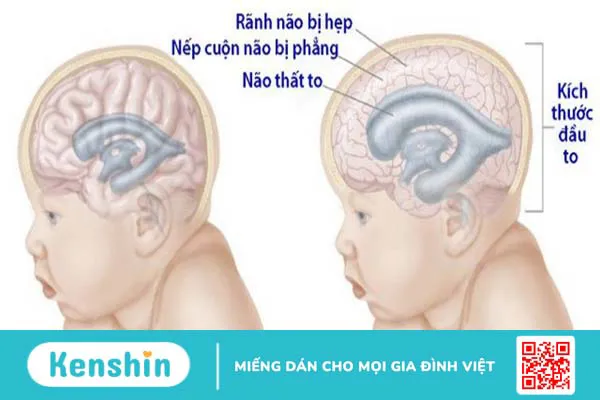 Não úng thủy bẩm sinh: Nguyên nhân, triệu chứng và phương pháp điều trị