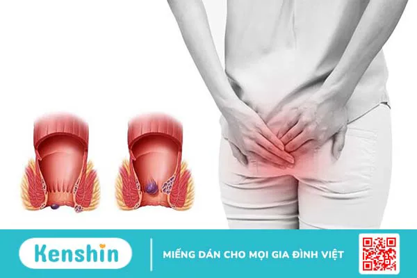 Nên khám trĩ ở đâu Hà Nội để đảm bảo chính xác? 1