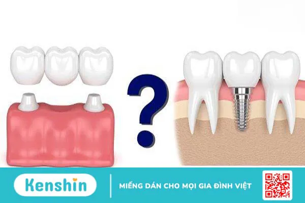 Nên làm cầu răng hay implant? Phương pháp nào tốt hơn?