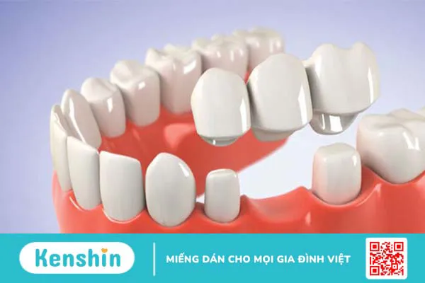 Nên làm cầu răng hay implant? Phương pháp nào tốt hơn? 1