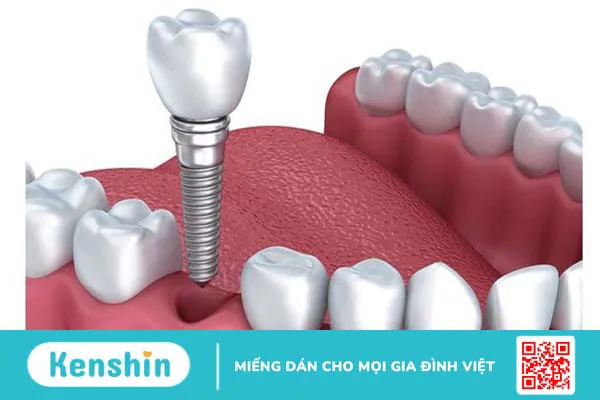 Nên làm cầu răng hay implant? Phương pháp nào tốt hơn? 2