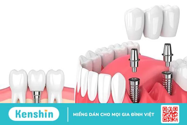 Nên làm cầu răng hay implant? Phương pháp nào tốt hơn? 3