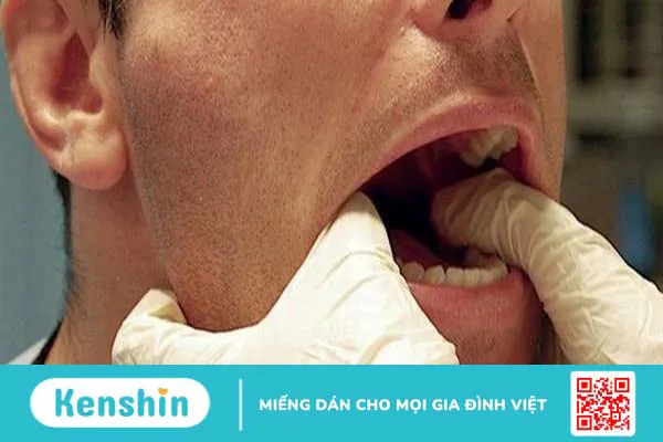 Nên làm gì khi bị sái quai hàm?