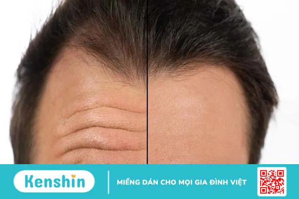 Nếp nhăn trên trán nói lên điều gì? Mẹo hạn chế nếp nhăn trên trán