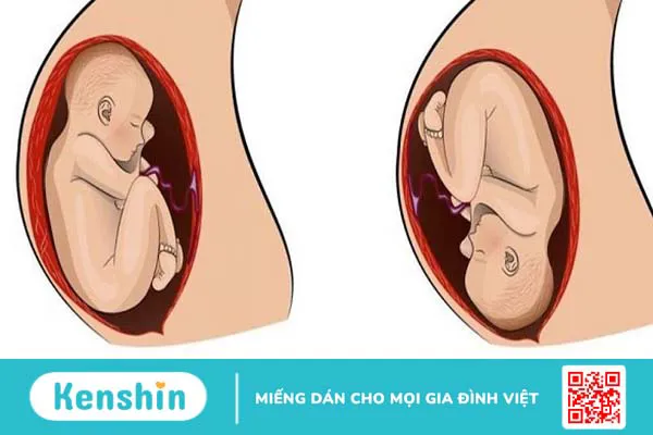 Ngôi thai bất thường: Nguyên nhân, chẩn đoán và hướng xử trí