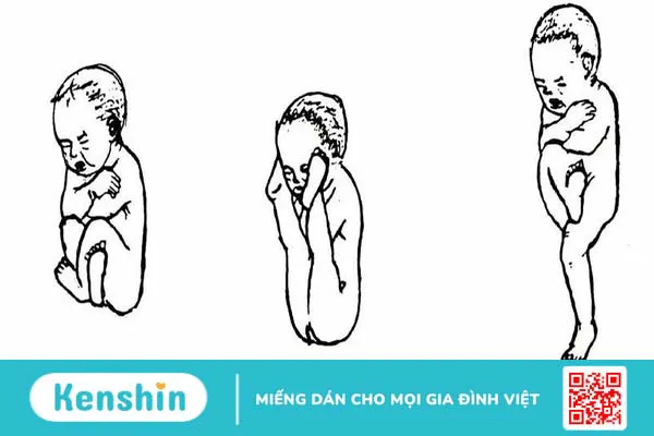 Ngôi thai ngược: Hiểu rõ về tình trạng và cách xử lý an toàn