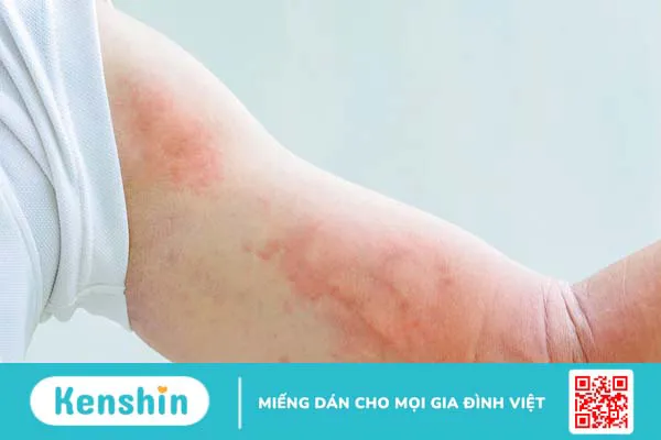 Ngứa da sau khi đi bơi liệu có sao không?