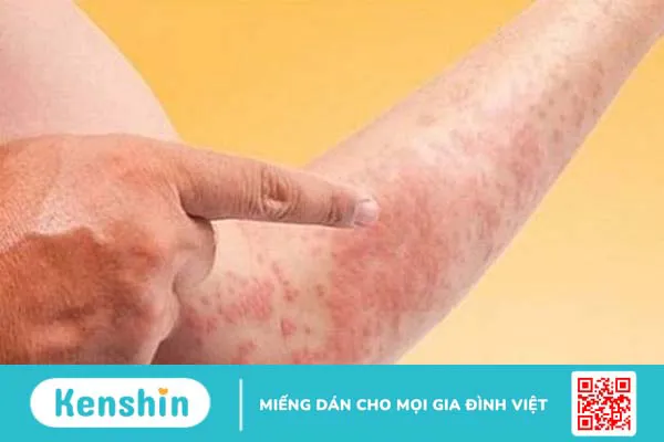 Ngứa da sau khi đi bơi liệu có sao không?