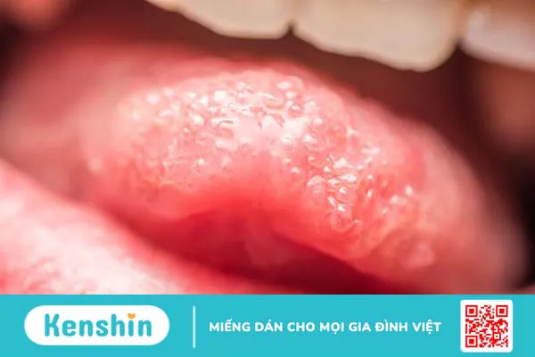 Ngứa lưỡi: Triệu chứng nói lên sức khỏe không ổn định của bạn