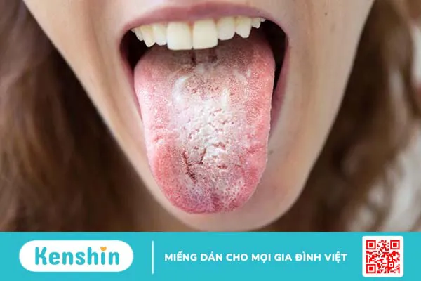 Ngứa lưỡi: Triệu chứng nói lên sức khỏe không ổn định của bạn