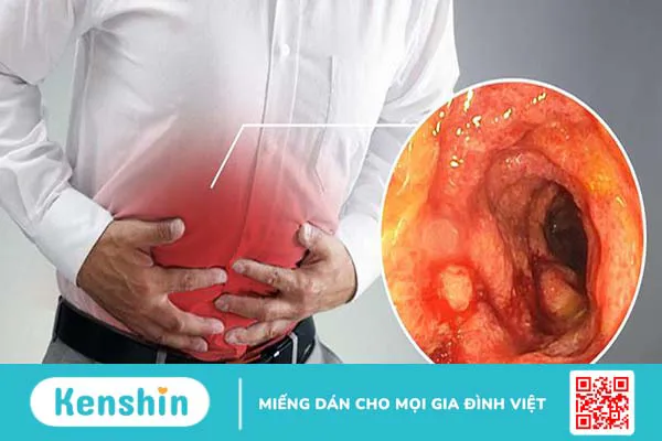 Người bệnh viêm trực tràng kiêng ăn gì và nên ăn gì?