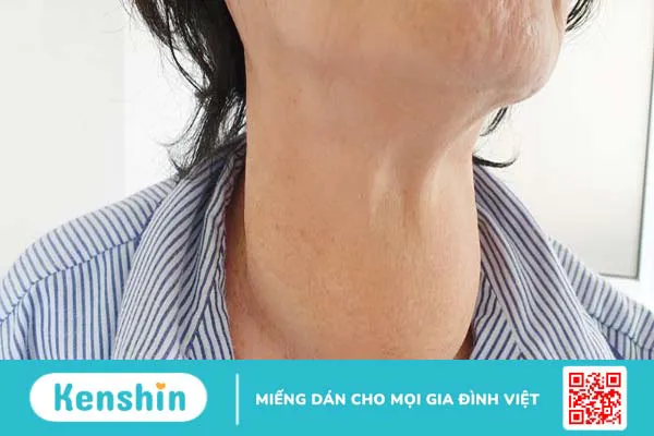 Người bị bướu cổ ăn thịt bò được không? Thực phẩm nào tốt cho người bị bướu cổ?