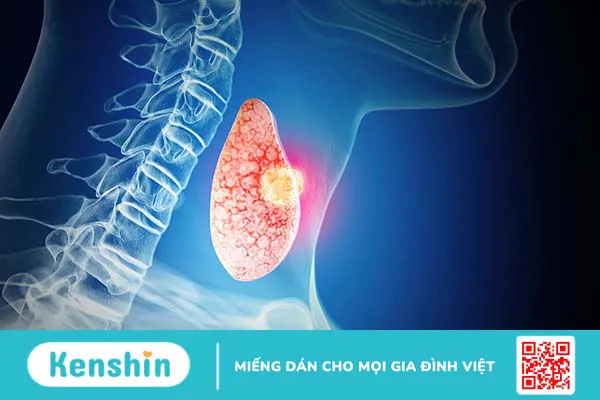 Người bị bướu cổ có nên uống bột sắn dây không?