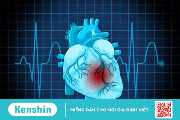 Nguyên nhân dẫn đến tình trạng loạn sản thất phải gây rối loạn nhịp tim