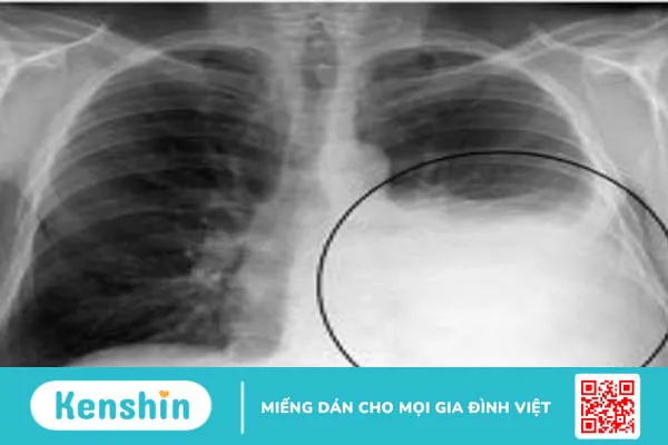 Nguyên nhân gây mệt mỏi khó thở và cách xử lý