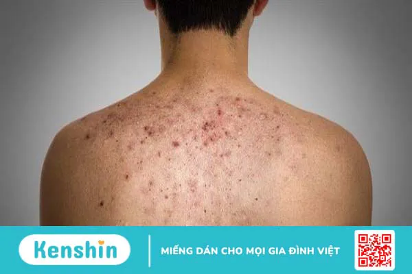 Nguyên nhân gây mụn lưng nam giới và cách điều trị