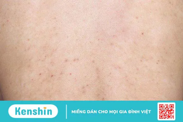 Nguyên nhân gây mụn lưng nam giới và cách điều trị