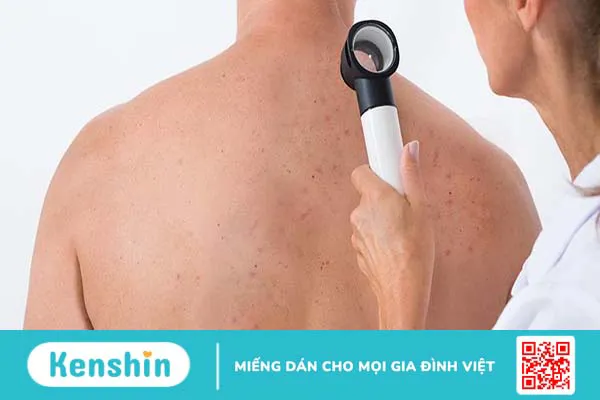 Nguyên nhân gây mụn lưng nam giới và cách điều trị