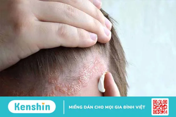 Nguyên nhân gây ngứa da đầu và cách khắc phục với dầu gội Nazorel 2