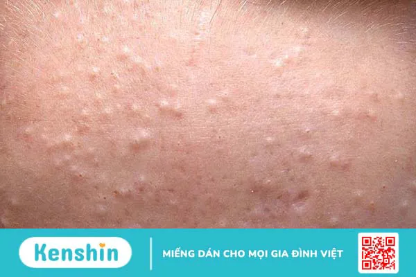 Nguyên nhân gây ra mụn ẩn là gì? Cách điều trị mụn ẩn