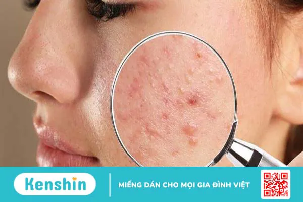 Nguyên nhân gây ra mụn ẩn là gì? 2