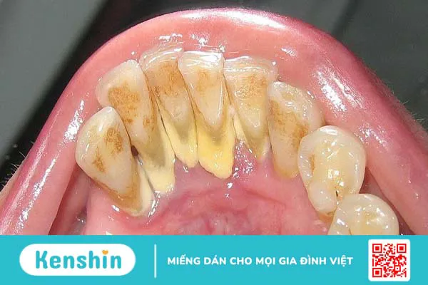 Nguyên nhân khiến cao răng tự vỡ và những điều cần lưu ý