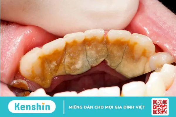 Nguyên nhân khiến cao răng tự vỡ và những điều cần lưu ý