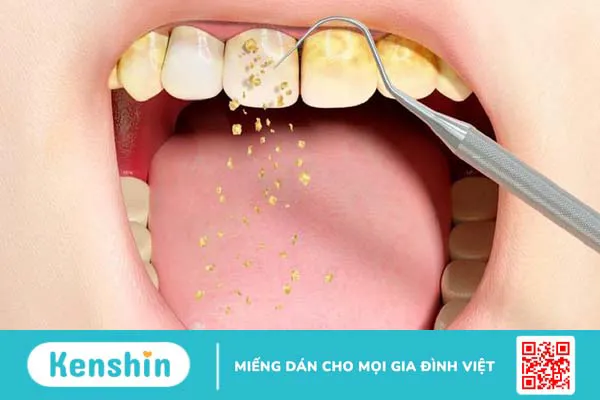 Nguyên nhân khiến cao răng tự vỡ và những điều cần lưu ý