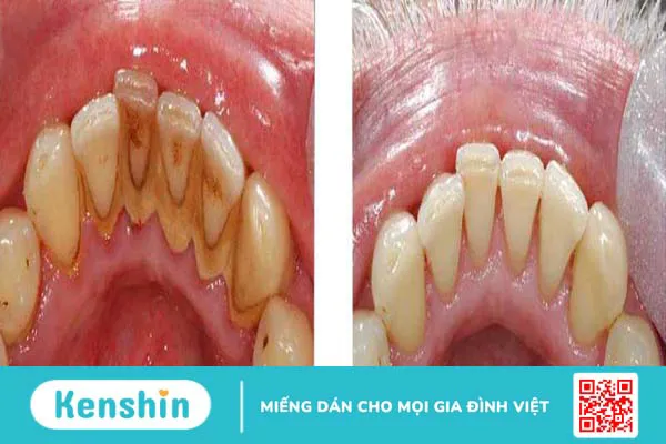 Nguyên nhân khiến cao răng tự vỡ và những điều cần lưu ý