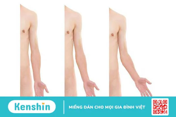 Nguyên nhân của khuỷu tay bị cong bẩm sinh là gì? Phương pháp điều trị như thế nào? 1